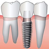 Our Dental Implant Services