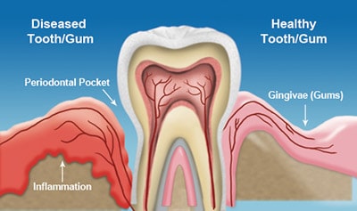 Gum Disease treatment